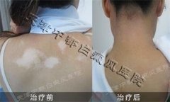 <b>天津天津女性背部白癜风的康复治疗</b>