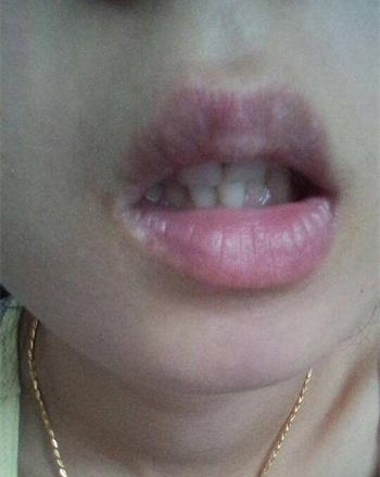 天津患者嘴唇上有小白点是怎么回事