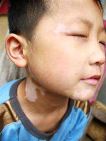 白癜风会对天津儿童造成哪些伤害